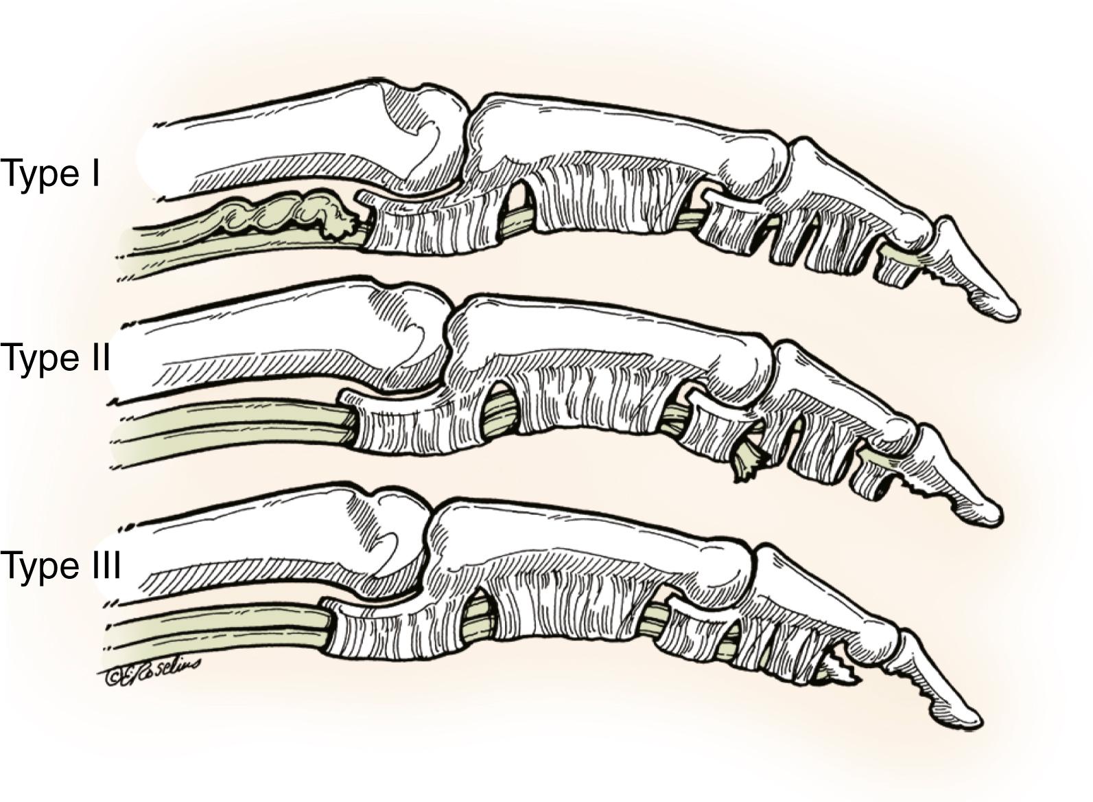 Fig. 6.7, Leddy and Packer classification of profundus avulsions. Type I: The FDP tendon is avulsed from its insertion and retracts into the palm. Type II: The profundus tendon is avulsed from its insertion, but the stump remains within the digital sheath, implying that the vinculum longum is still intact. Type III: A bony fragment is attached to the tendon stump, which remains within the flexor sheath. Further proximal retraction is prevented at the distal end of the A4 pulley.