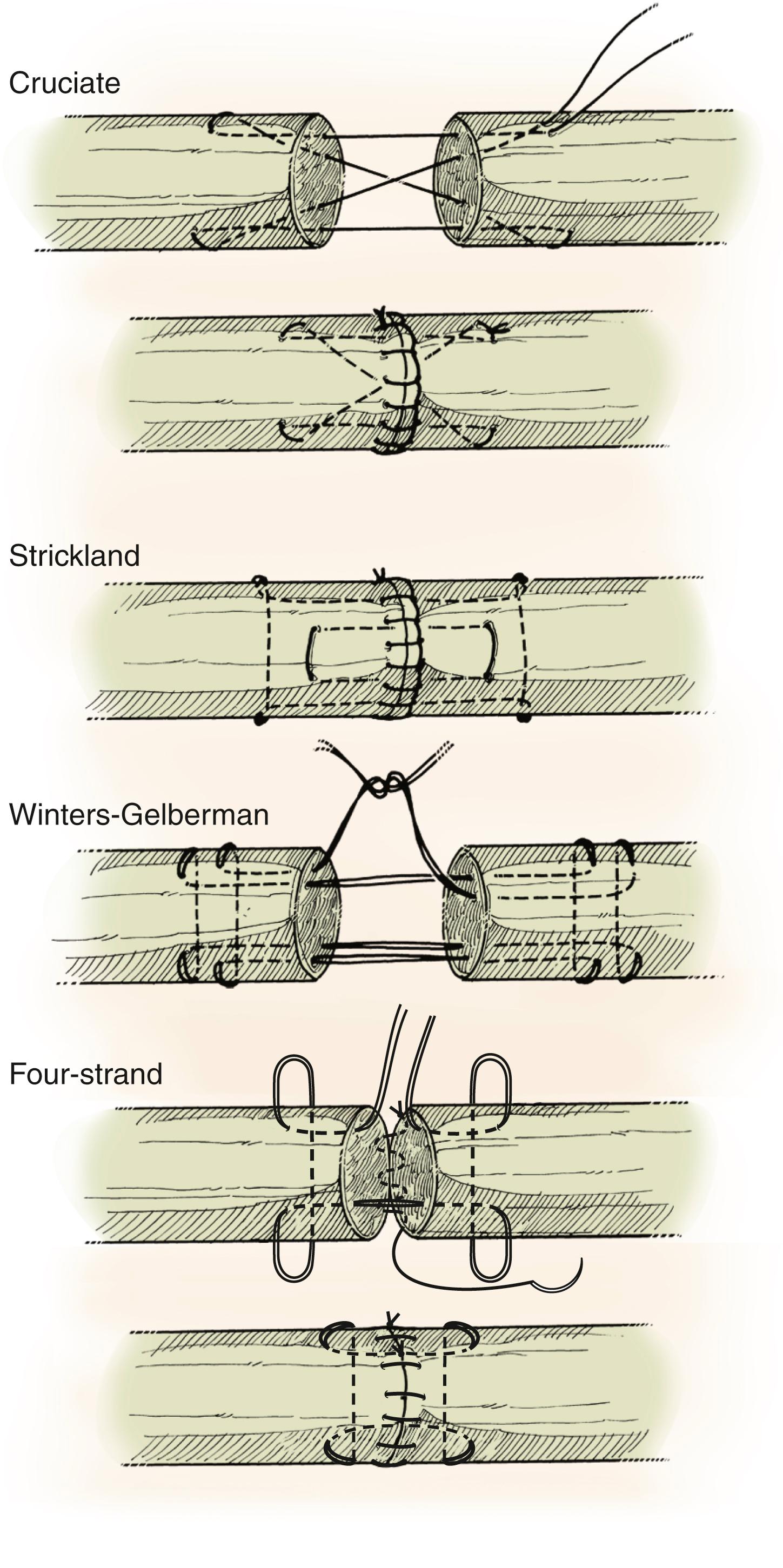 Fig. 6.8, Methods commonly used for end-to-end flexor tendon repair.