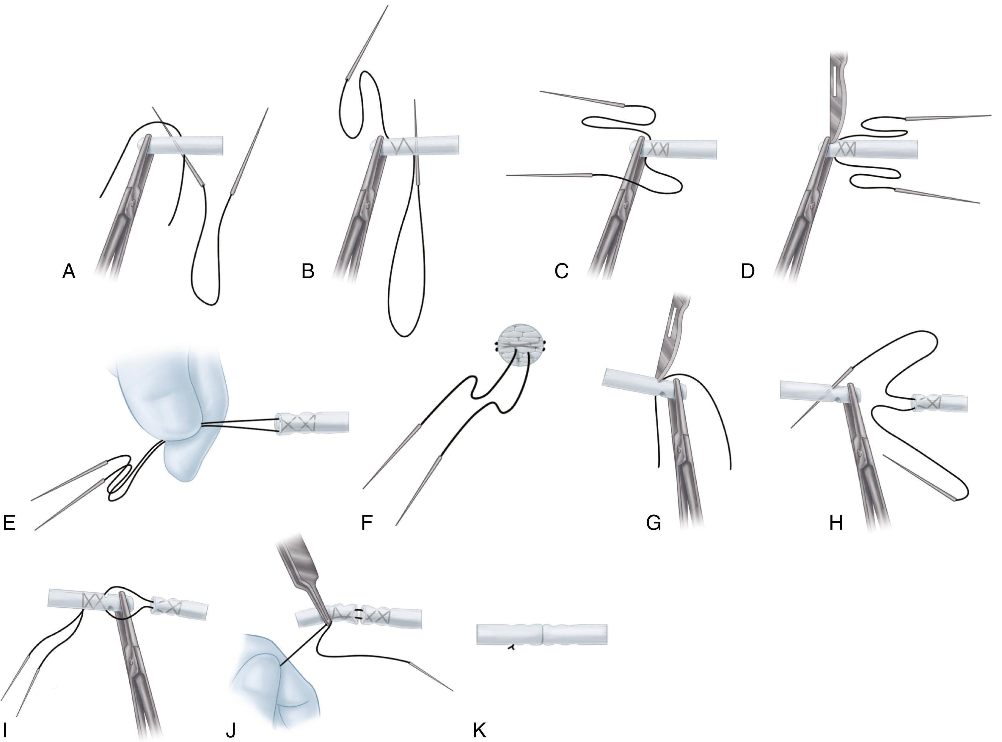 FIGURE 66.125, A-K, End-to-end suture of tendon using Bunnell crisscross stitch (see text).