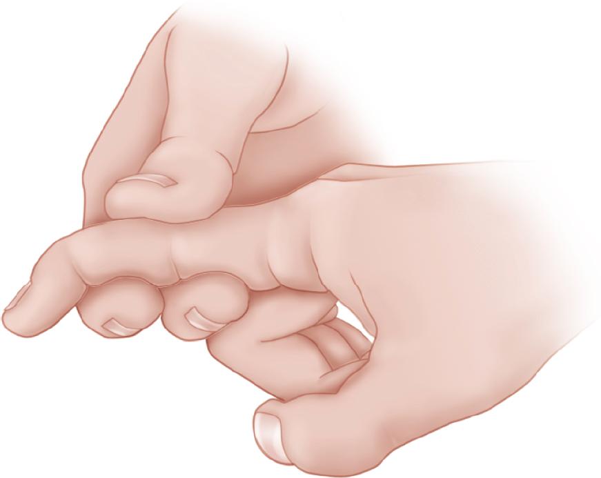 FIGURE 66.13, If distal interphalangeal joint can be actively flexed while proximal interphalangeal joint is stabilized, profundus tendon has not been severed.