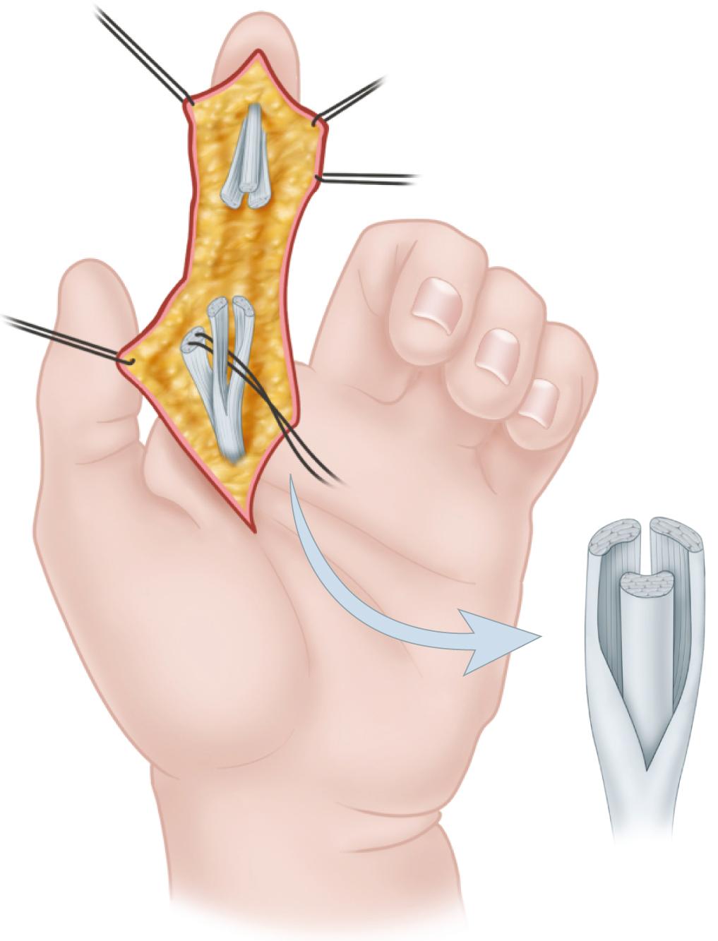 FIGURE 66.133, Separated position of two tendon ends in distal palm after flexor tendon interruption and proximal retraction. Profundus must be correctly positioned in sublimis hiatus before passing tendons distally into digit. Anatomic relationship of profundus and sublimis tendon stumps must be reestablished so that they can be correctly repaired to corresponding distal tendon stumps. In some cases, profundus must be passed back through hiatus created by sublimis slips to lie palmar to Camper chiasma and to recreate position of tendons at level of tendon laceration.