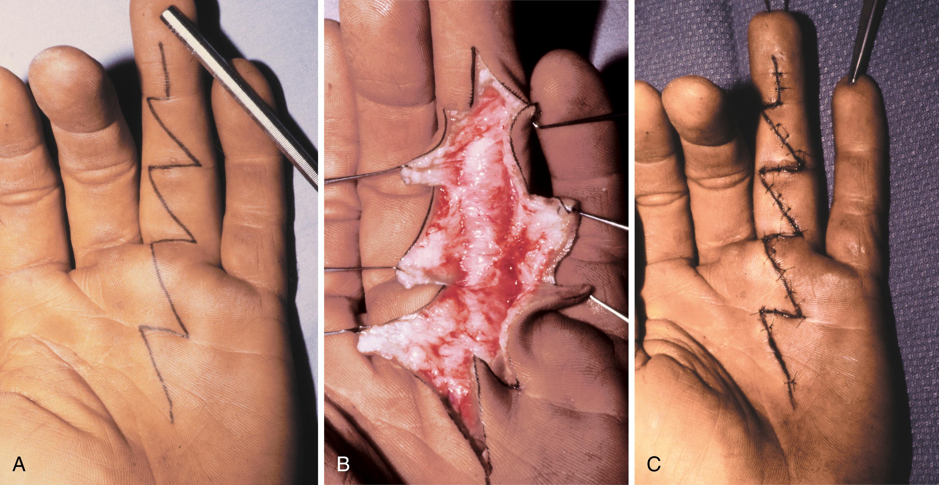 FIGURE 66.135, A, Incision outlined on digit and palm. B, Exposure of flexor tendon sheath after flap elevation. C, Closed incision. SEE TECHNIQUE 66.10.