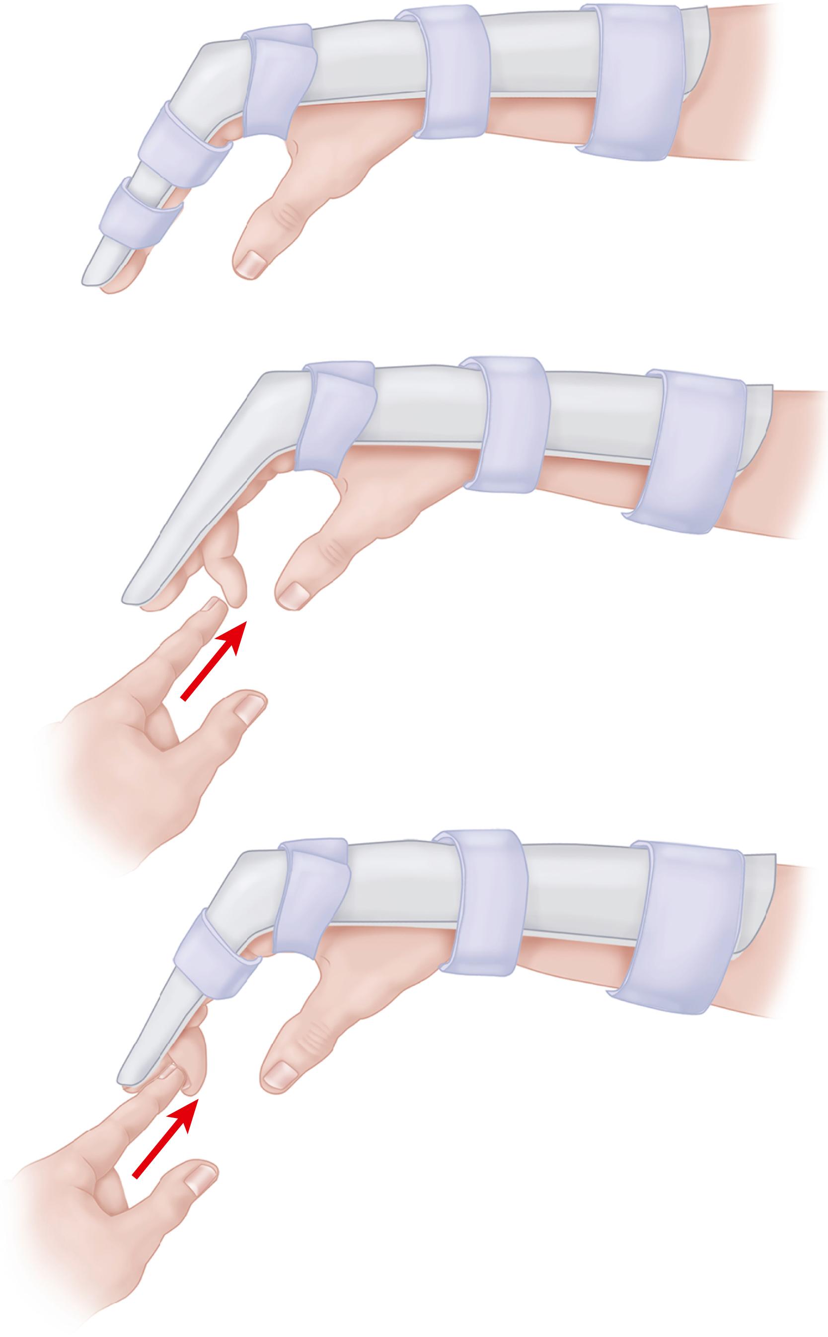 FIGURE 66.140, Passive flexion of interphalangeal joints, which is done several times each day for 4 to 5 weeks. Duran and Houser popularized early passive motion after tendon repair.