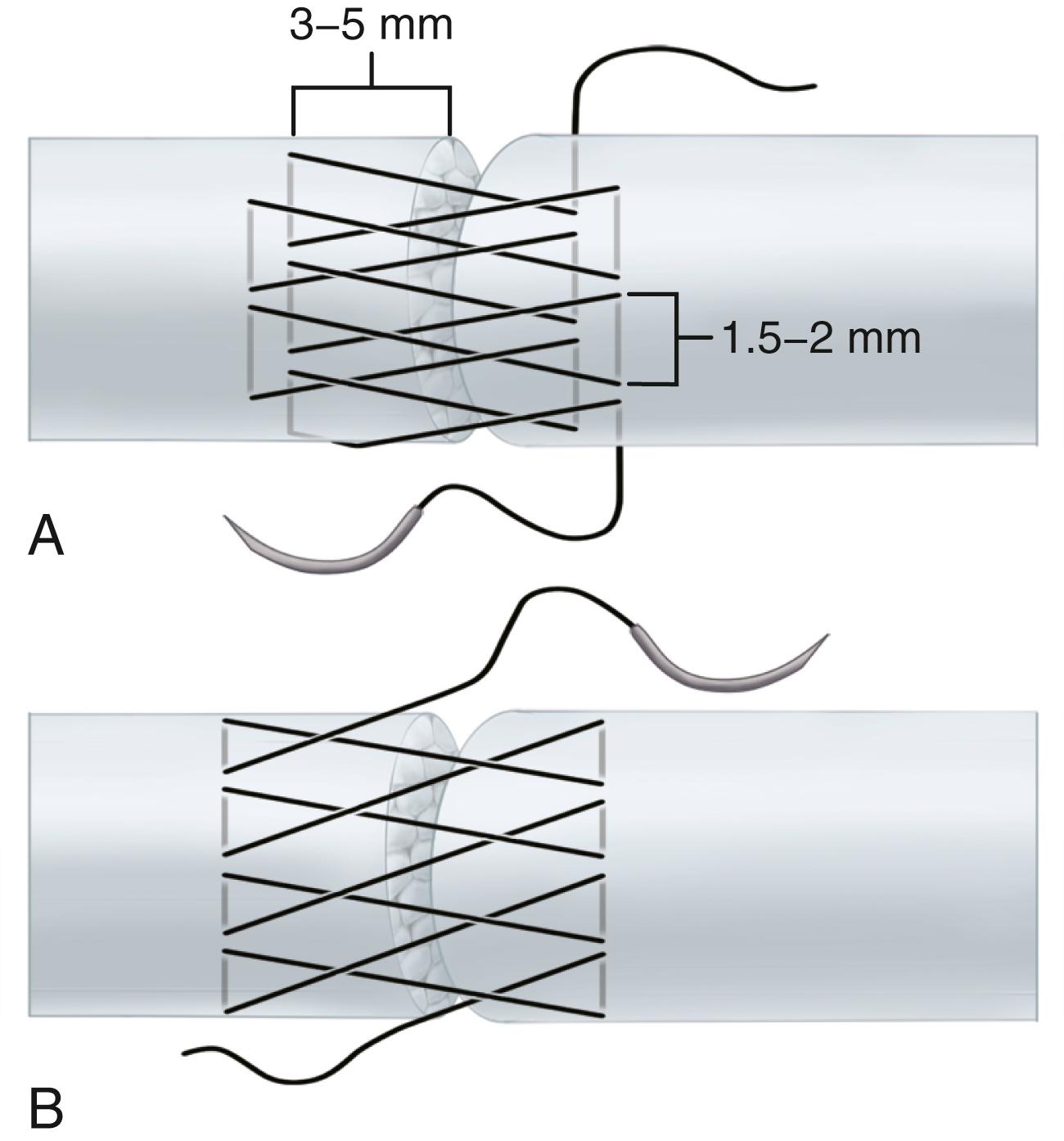 FIGURE 66.19, Two basic versions of cross-stitch. A, Suturing starts on far side of repair and proceeds toward operator. Simple overlap of each preceding grasp by approximately 50% automatically produces weave pattern without need for special needle passages. Symmetric placement of grasps (used here for clarity) is unnecessary in actual practice. Grasp size, overlap, and distance to tendon edge can be adapted to needs as suturing progresses. B, Suturing starts on near side of repair; overlapping is unnecessary.