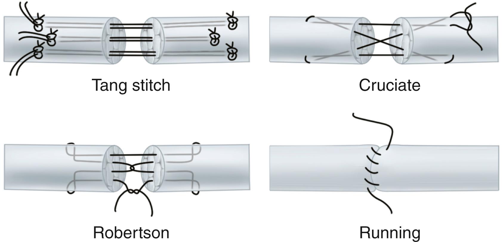FIGURE 66.110, Tendon suture techniques. (See text.)