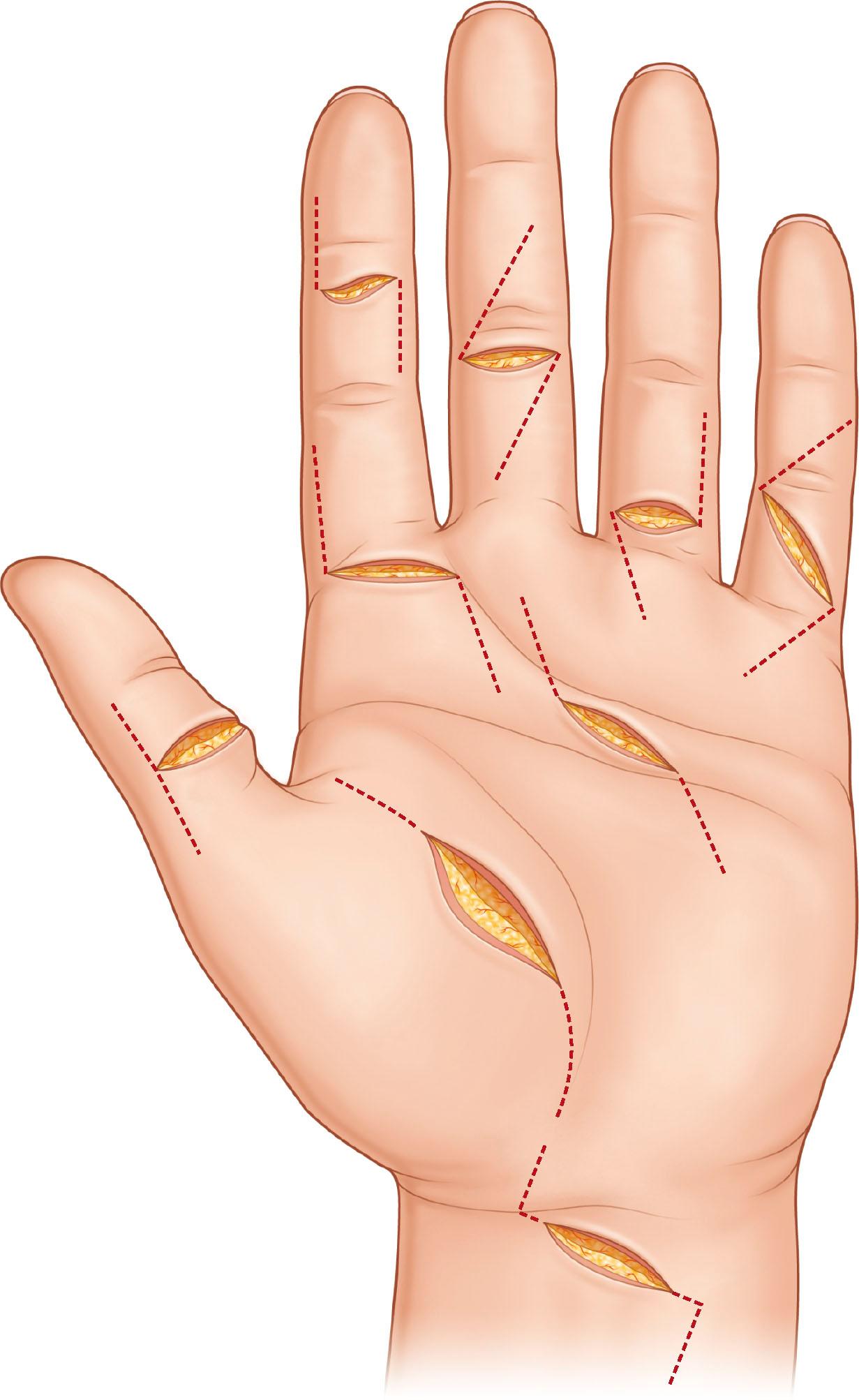 Figure 9.11, Skin incisions utilized to approach the tendons in the digits and palm.