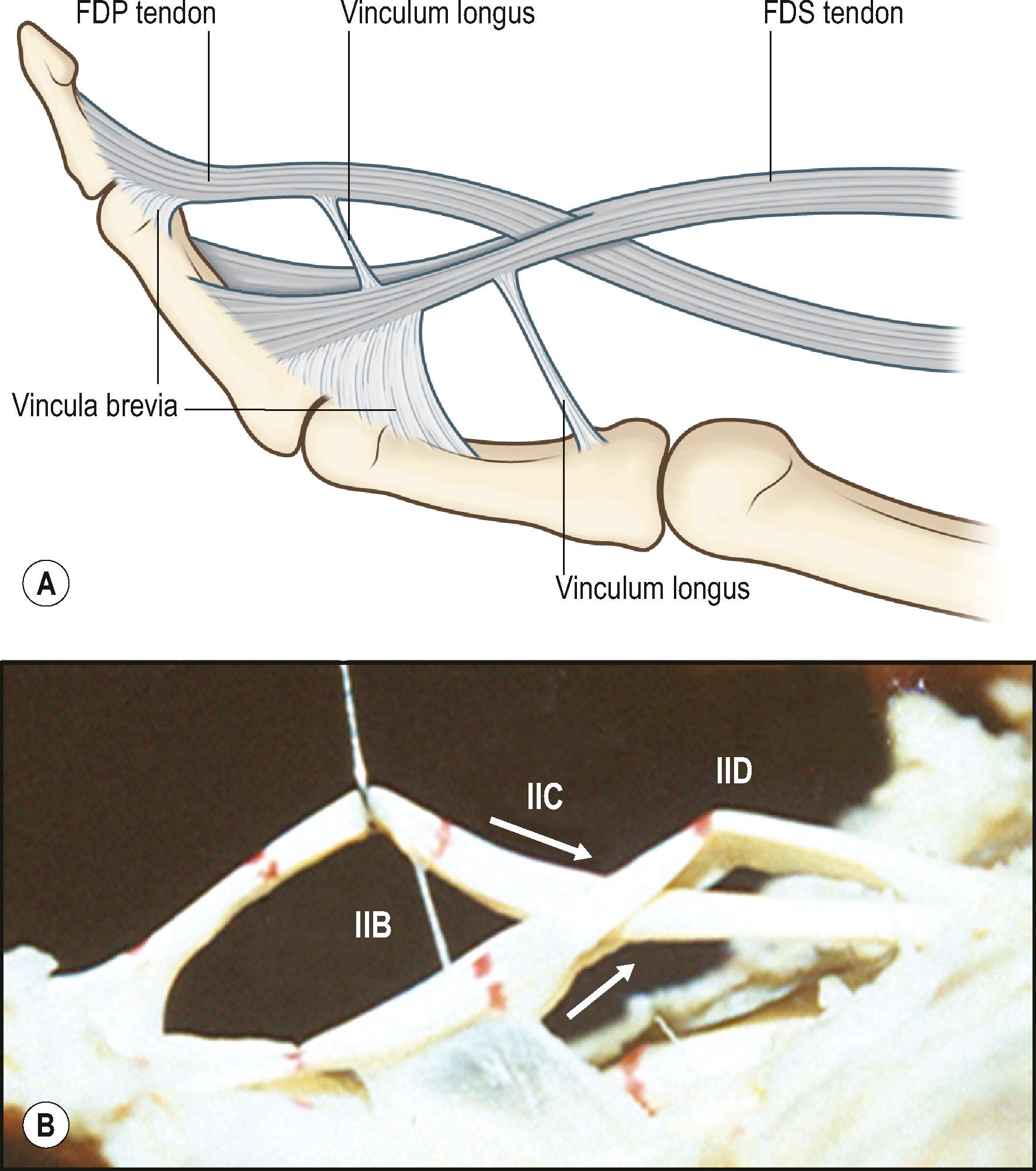 Figure 9.3, Insertions and relative positions of the flexor digitorum superficialis (FDS) and flexor digitorum profundus (FDP) tendons and vincula. Each of the FDS and FDP tendon has two vincula, one short and one long. The relation of the FDS and FDP tendons are complex in the middle part of the proximal phalanx under the A2 pulley (zone 2 C).