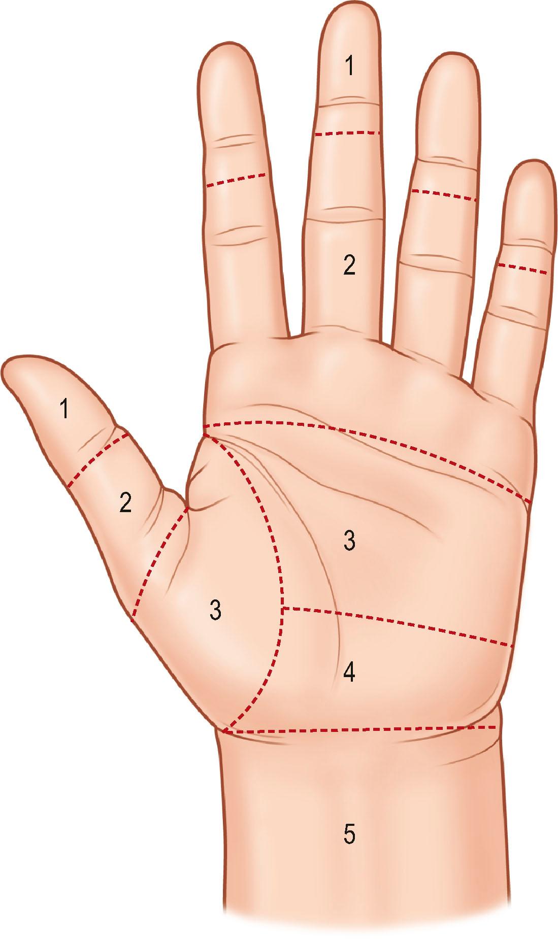 Figure 9.4, Divisions of the flexor tendons into five zones according to anatomical structures of the flexor tendons, presence of the synovial sheath, and the transverse carpal ligament.