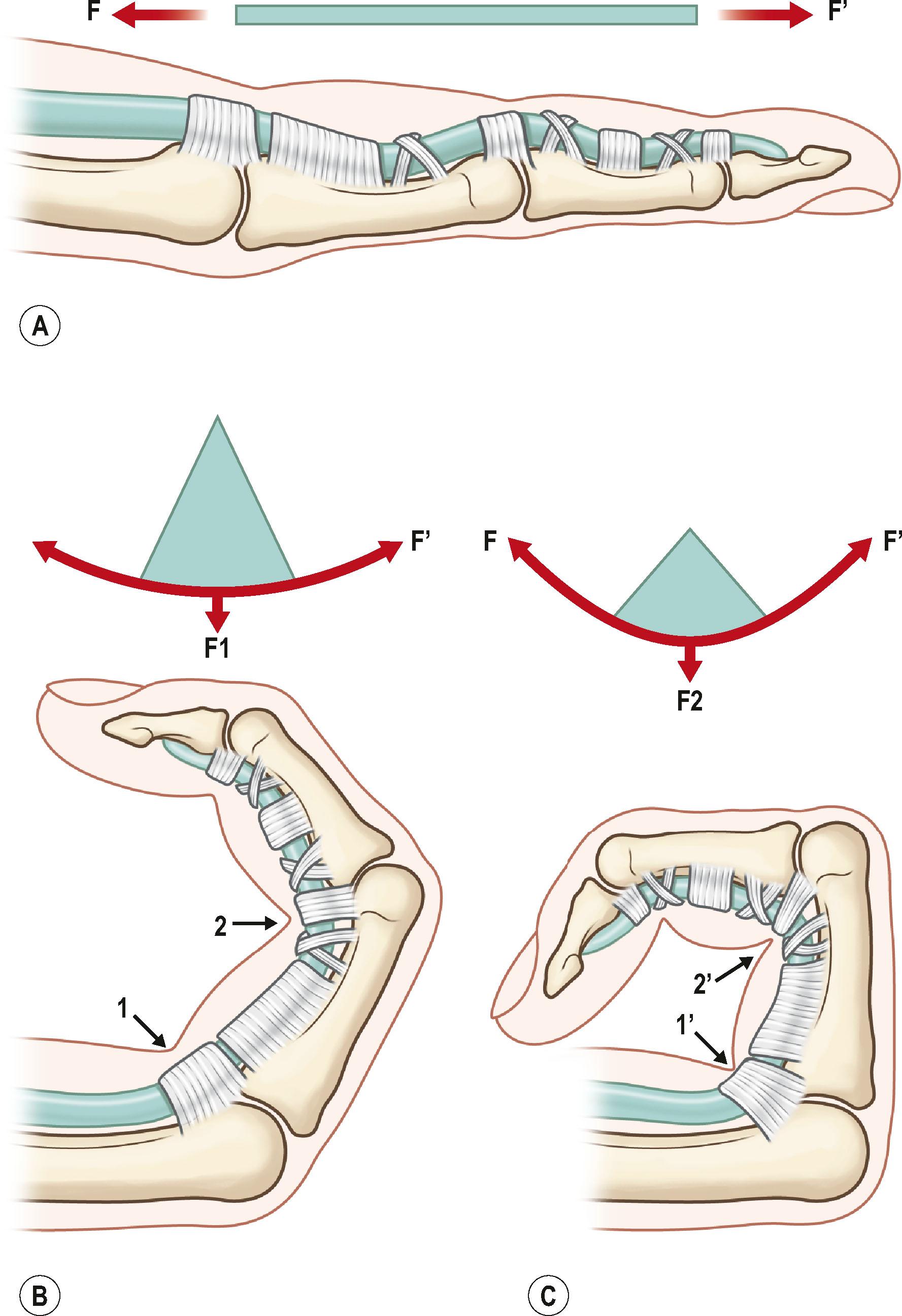 Figure 9.8, The forces acting on the tendon are different when the tendon is subjected to linear pulling (A) or a curvilinear tension (B,C) . (A) The tendon subjected to linear pulling is loaded by only a linear pulling force. (B,C) The tendon subjected to a curvilinear tension is loaded by both linear and bending forces. The repaired tendon fails more easily while being linearly pulled and bent. From (B) to (C) , as the curvature of the gliding path increases, the bending force on the tendon is increased (F2>F1). Under greater gliding curvature, the tendon fails with a smaller linear pulling force. From (B) to (C) , as the finger flexes progressively, the tendon fails with an increasingly smaller linear tension. (C) The tendon is particularly prone to fail when the finger approaches full flexion. The tendon is easier to disrupt in (C) when gliding over joints (1′ and 2′) with greater curvature than in (B) with smaller curvature.