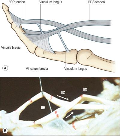 Figure 24.4, Insertions and relative positions of the flexor digitorum superficialis (FDS) and flexor digitorum profundus (FDP) tendons and vincula. Each of the FDS and FDP tendons has two vincula, one short and one long. The relations of the FDS and FDP tendons are complex in the middle part of the proximal phalanx under the A2 pulley (zone 2C).