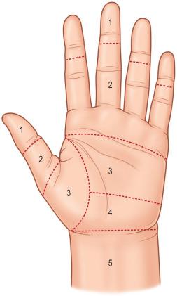 Figure 24.5, Division of the flexor tendons into five zones according to anatomical structures of the flexor tendons, presence of the synovial sheath, and the transverse carpal ligament.