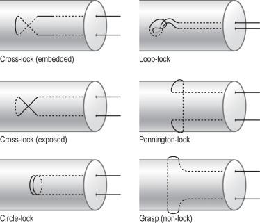 Figure 24.8, Different tendon–suture junctions in tendon repairs: locking and grasping junctions.