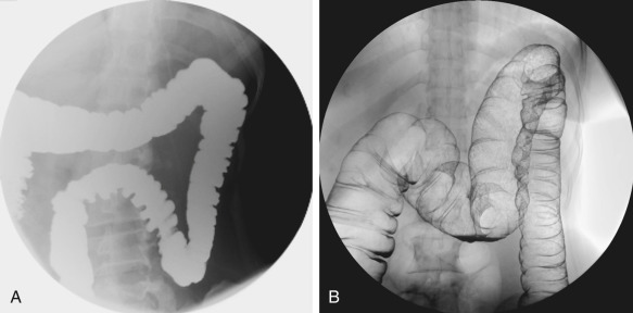 Figure 2-2, Spot radiograph of the mid-transverse colon obtained during single-contrast (A) and double-contrast (B) barium enema. The mucosal details are well seen on the double-contrast study.