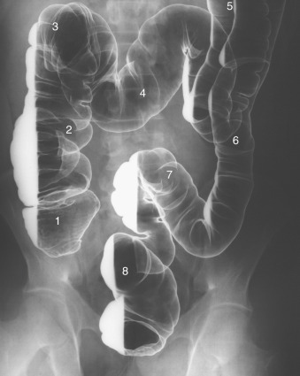 Figure 26-1, Normal colon on double-contrast barium enema examination. 1 = cecum, 2 = ascending colon, 3 = hepatic flexure, 4 = mid-transverse colon, 5 = splenic flexure (partially imaged), 6 = descending colon, 7 = sigmoid colon, and 8 = rectum.