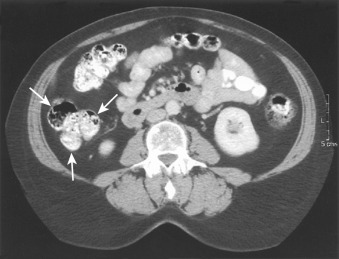 Figure 26-2, Colonic haustra on CT. Axial image through lower abdomen shows three rows of haustral sacculations ( arrows ) in ascending colon. Feces in ascending colon have mottled appearance of black air; soft tissue appears gray; oral contrast material appears white. Feces are not seen in mid–small bowel loops.