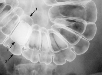 Figure 26-3, Colonic haustra on double-contrast barium enema examination. Spot radiograph of transverse colon shows three rows of haustral sacculations (edges of three haustral rows are identified by black arrows and numbered). Most dependent haustral row is partially filled with barium.