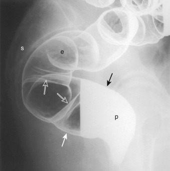 Figure 26-4, Normal rectum on double-contrast barium enema examination. Spot radiograph of rectum where patient lies in prone position and x-ray beam is “shot” across patient; this is termed cross-table image . Mucosal detail is seen en face in air contrast ( e ), but obscured by barium pool ( p ). Radiologist looks at contour of colon in barium pool ( black arrow ) and in air ( white arrow ). Two valves of Houston are identified ( open arrows ). Proximal and midrectum parallel the sacrum ( s ).