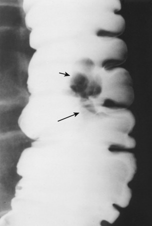 Figure 26-5, Colonic polyp on single-contrast barium enema examination. Spot radiograph of ascending colon. Radiologist evaluates contour and barium column. In this patient, luminal contour has normal sacculations. There is a 1.5-cm lobulated radiolucent filling defect ( short arrow ) connected to smooth tubular filling defect ( long arrow ), typical of pedunculated polyp. Barium in interstices of lesion indicates its villous or tubulovillous nature. Polyp proved to be tubulovillous adenoma.