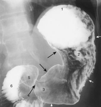 Figure 24-2, Normal stomach and proximal duodenum on double-contrast upper GI examination. 1 = gastric fundus, 2 = gastric body, 3 = gastric antrum, 4 = pylorus (pyloric channel), 5 = duodenal bulb, and 6 = second portion of duodenum. Black arrows indicate lesser curvature of stomach. White arrows indicate greater curvature of stomach.