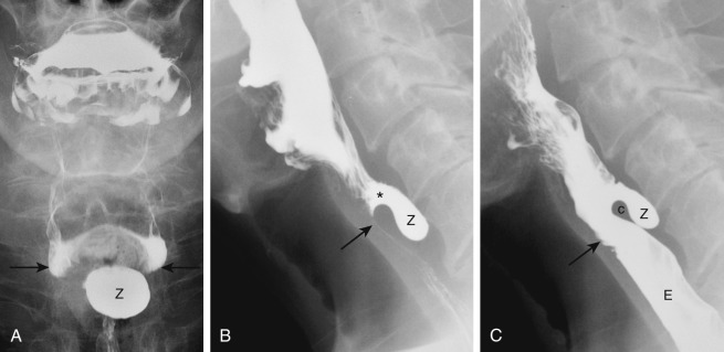Figure 24-7, Zenker's diverticulum on pharyngoesophagogram. A, Image obtained while patient stands in frontal position. Note 2 × 3 cm smooth-surfaced, ovoid sacculation ( Z ) in midline below tips of piriform sinuses ( arrows ). B and C, Images obtained while patient drinks barium and stands in lateral position. In B , barium contrast bolus has just arrived in distal hypopharynx. Barium goes through opening of diverticulum (*) and fills sac ( Z ). Pharyngoesophageal segment ( arrow ) has not yet opened. In C , barium contrast bolus has now nearly completely passed through pharynx into cervical esophagus ( E ). Pharyngoesophageal segment ( arrow ) is now open. Zenker's diverticulum ( Z ) is seen posterior to cricopharyngeal muscle ( c ) and uppermost portion of posterior wall of cervical esophagus.