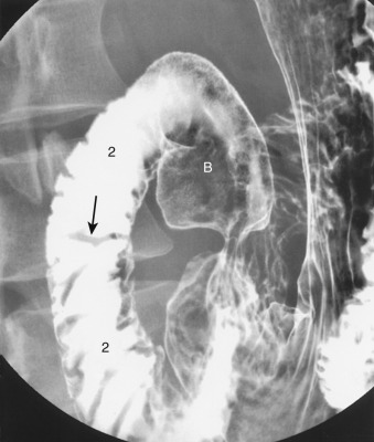 Figure 24-8, Proximal duodenum on double-contrast upper GI examination. Spot radiograph shows duodenal bulb ( B ) and second portion of duodenum ( 2 ). Duodenal folds (folds of Kerckring) ( arrow ) cross duodenum except at level of papilla of Vater.