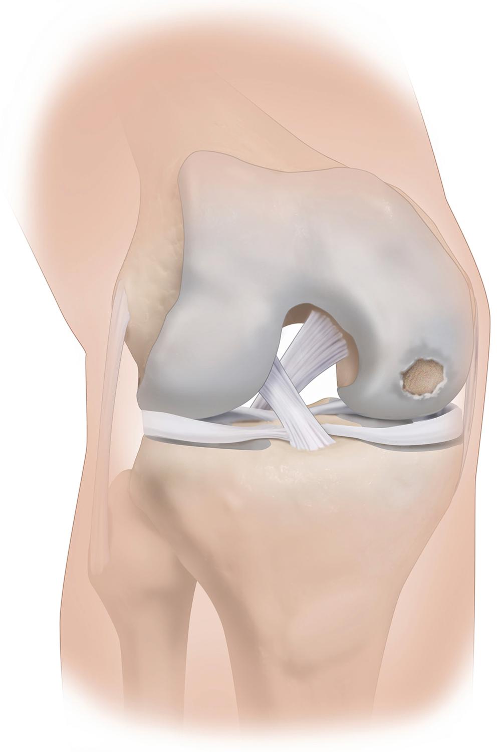 Fig. 22.1, Illustration representing a focal chondral defect on the femoral medial epicondyle.