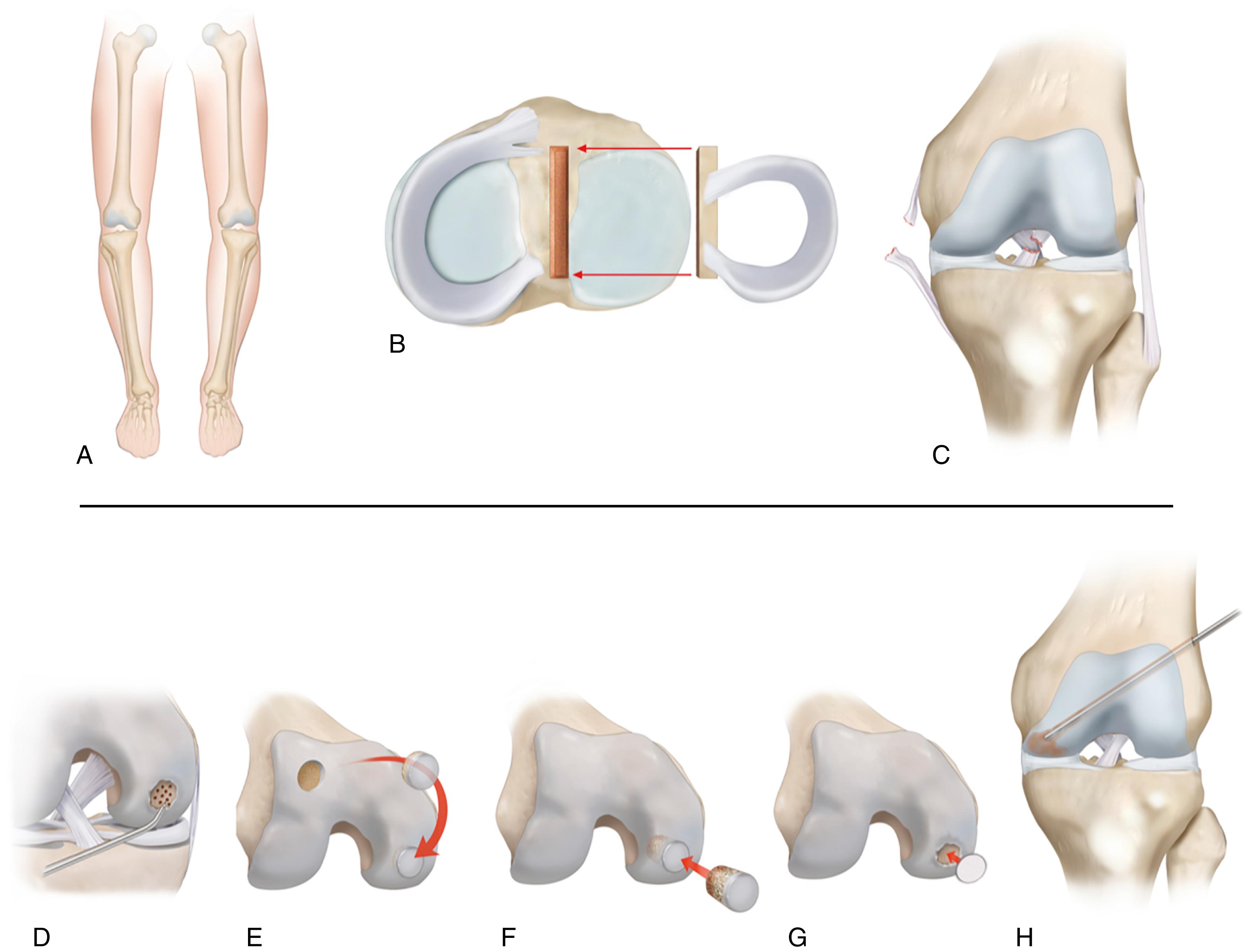 Fig. 22.3, Treatment algorithm for focal chondral defect (FCD).