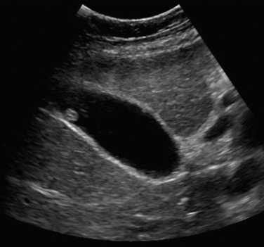 Figure 57-2, Tubular adenoma of the gallbladder in a 56-year-old woman with epigastric discomfort. Transverse ultrasound image shows an echogenic, rounded polyp attached to the gallbladder wall.