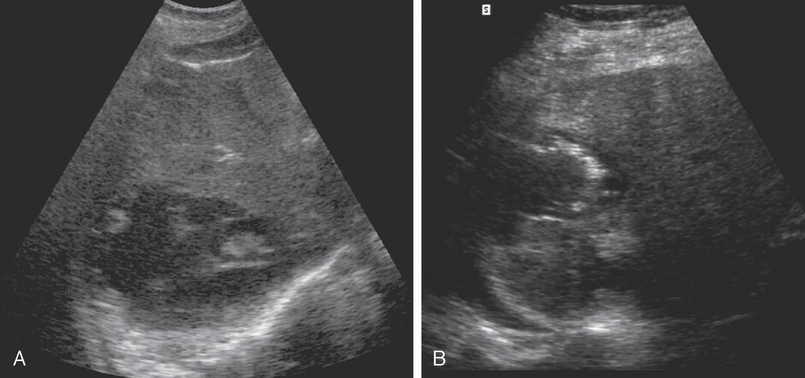 Fig. 55.1, Pyogenic liver abscess: sonographic features.