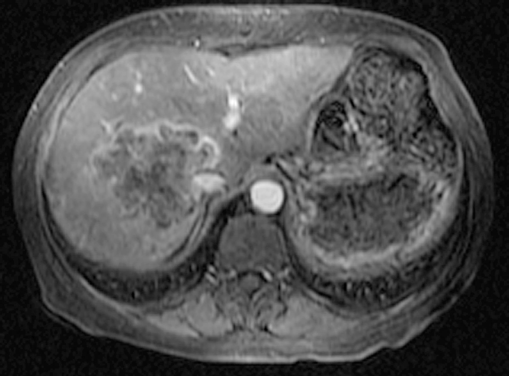 Fig. 55.2, Pyogenic liver abscess: magnetic resonance imaging findings.