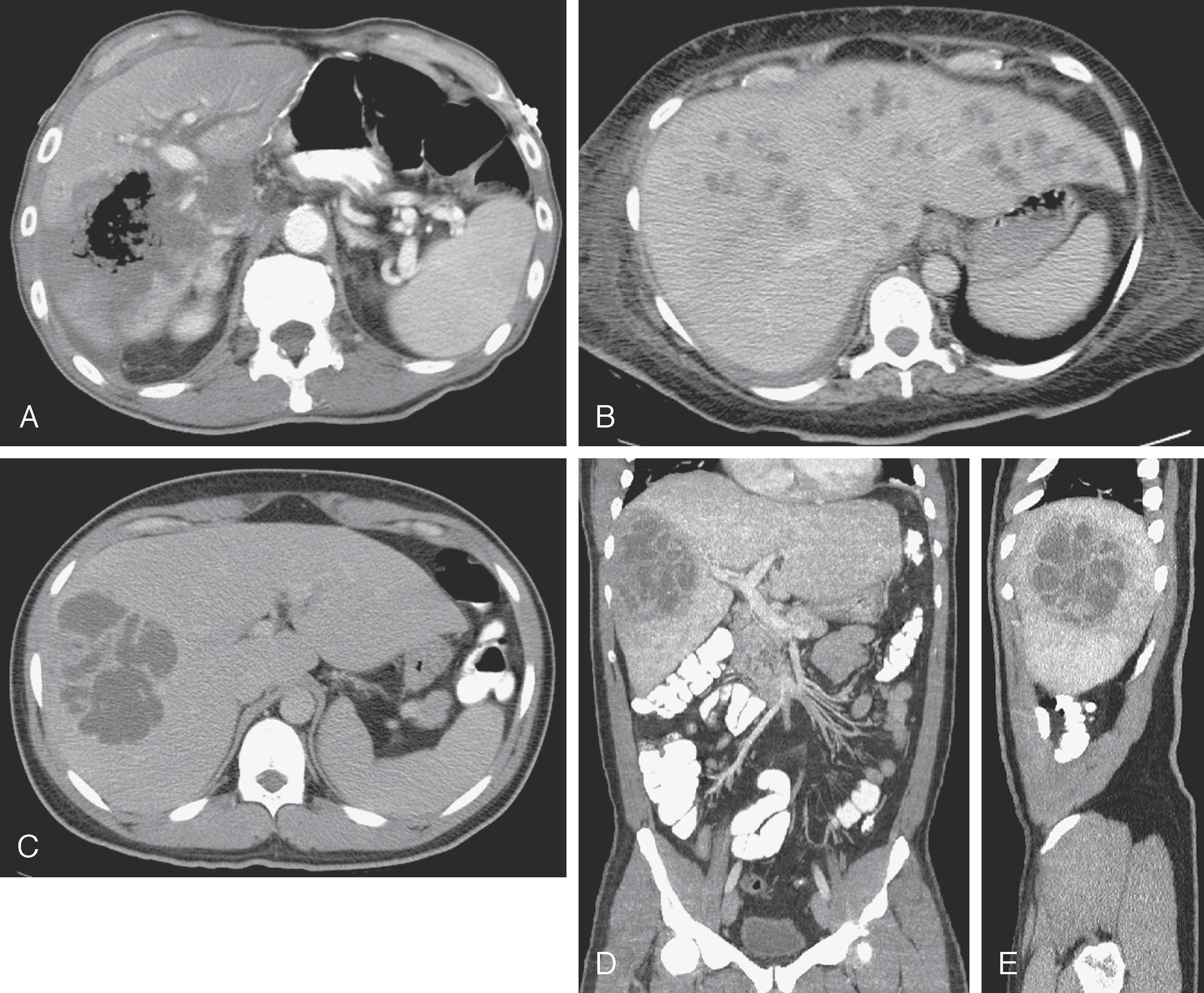 Fig. 55.3, Pyogenic liver abscess: computed tomography findings.