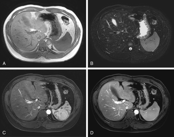 Figure 59-11, Splenic hamartoma. Axial T1-weighted (A), T2-weighted (B), early contrast-enhanced (C), and late contrast-enhanced (D) magnetic resonance images show a round splenic lesion (arrows) with iso-signal to slightly low signal intensity on T1- and T2-weighted images ( A and B ), heterogeneous character, good enhancement on arterial phase image (C), and more uniform enhancement on the portal phase image (D) The patient underwent ultrasonography-guided biopsy. Histopathologic diagnosis was splenic hamartoma.