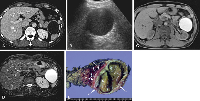 Figure 59-2, Epithelial (epidermoid) cyst in an intrapancreatic accessory spleen. A, Axial contrast-enhanced computed tomography scans show a round, unilocular low-attenuation lesion around the pancreas tail. Also noted is another accessory spleen in the left anterior aspect of the cyst. B, Oblique coronal ultrasound image shows fine granular echo of the cyst contents and posterior acoustic enhancement. C, On axial fat-suppressed T1-weighted magnetic resonance imaging, the signal of the cyst contents appears hyperintense. D, Hyperintense signal of the cyst contents and fluid/fluid level is demonstrated on an axial fat-suppressed T2-weighted image. E, The patient underwent splenectomy. The gross specimen shows the cystic mass (arrows) with a glistening inner surface and some trabeculation. Histopathologic diagnosis was an epidermoid cyst in an intrapancreatic accessory spleen.