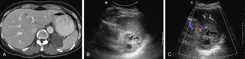 Figure 59-4, Splenic pseudocyst. A, Axial contrast-enhanced computed tomography scan shows a well-demarcated, spherical low-attenuation mass. Also noted are the peripheral curvilinear calcifications (arrows). B, A round, mixed echoic lesion is seen with marked posterior echo enhancement on this oblique coronal ultrasound image. The heterogeneous echo pattern of the cyst contents may reflect internal debris or hemorrhage. C, Color Doppler ultrasonogram demonstrates avascularity of the lesion.