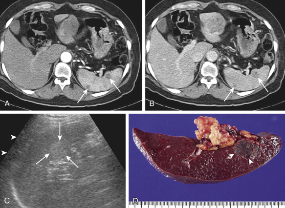 Figure 59-5, Splenic hemangiomas. A, Axial contrast-enhanced computed tomography (CT) scan during the arterial phase shows multiple low-attenuation nodules (arrows) in the spleen. B, On portal venous phase CT, diffuse low-grade enhancement of the lesions (arrows) is appreciated. C, Oblique coronal ultrasound image shows hyperechogenicity in one of the lesions (arrows). D, The patient underwent splenectomy. The cut surface of the gross specimen shows a well-demarcated purple-red mass (arrowheads). Histopathologic diagnosis was splenic cavernous hemangioma.