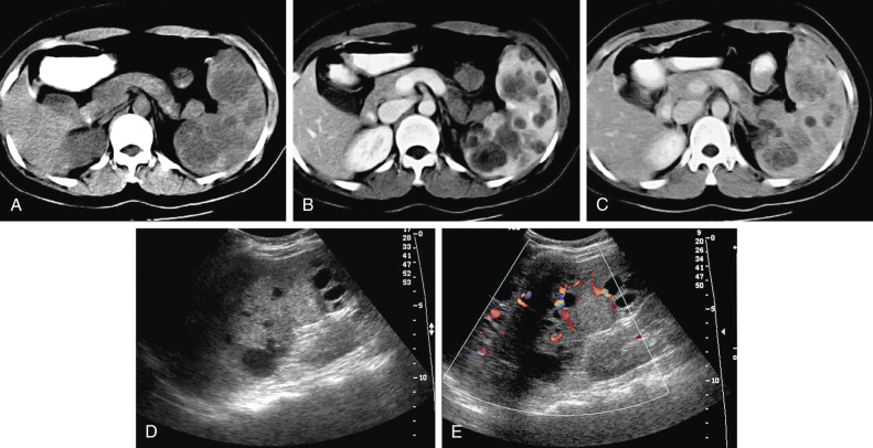 Figure 59-6, Splenic hemangiomas. A, Axial unenhanced computed tomography (CT) scan shows variable-sized multiple low-attenuation masses in the spleen. B and C, Contrast-enhanced CT scans during the arterial (B) and portal venous (C) phases demonstrate mild and gradual enhancement of the lesions. D, Oblique coronal ultrasonogram shows solid and cystic appearance of the lesions, seen as hyperechoic and anechoic compartments. E, Color Doppler ultrasonogram shows the hypervascularity in the solid portion of the splenic masses.