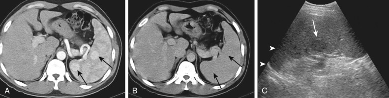 Figure 59-7, Splenic hemangiomas. A, Axial contrast-enhanced computed tomography (CT) scan during the arterial phase shows two nodular lesions (arrows) with homogeneous and intense contrast enhancement. B, The tumors appear as nearly isoattenuating lesions (arrows) compared with the surrounding spleen parenchyma on the delayed-phase CT. C, The lesion is hypoechoic (arrow) on an oblique coronal ultrasound image. The patient underwent splenectomy. Histopathologic diagnosis was splenic hemangioma.