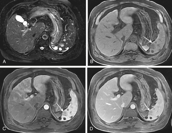 Figure 59-8, Splenic hemangiomas. Multiple nodules ( arrow, B ) in the spleen are seen as high signal intensity on the T2-weighted magnetic resonance (MR) image (A) and as low signal intensity on the T1-weighted image (B). Gadolinium-enhanced T1-weighted MR images during the arterial (C) and portal venous (D) phases reveal mild and prolonged enhancement in one of the lesions (arrows). The patient underwent splenectomy. Histopathologic diagnosis was splenic hemangioma.