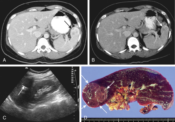 Figure 59-9, Splenic hamartoma. A, Axial contrast-enhanced computed tomography scan during the arterial phase shows a heterogeneously enhancing mass (arrow) in the anterior pole of the spleen. B, On delayed phase, this lesion (arrow) shows as an isoattenuated to slightly hyperattenuated mass. C, The lesion is seen as a hypoechoic mass (arrow) on an oblique coronal ultrasound image. D, The patient underwent splenectomy. The cut surface of the specimen reveals a well-circumscribed, dark-red solid nodular lesion (arrows). Histopathologic diagnosis was splenic cavernous hamartoma.