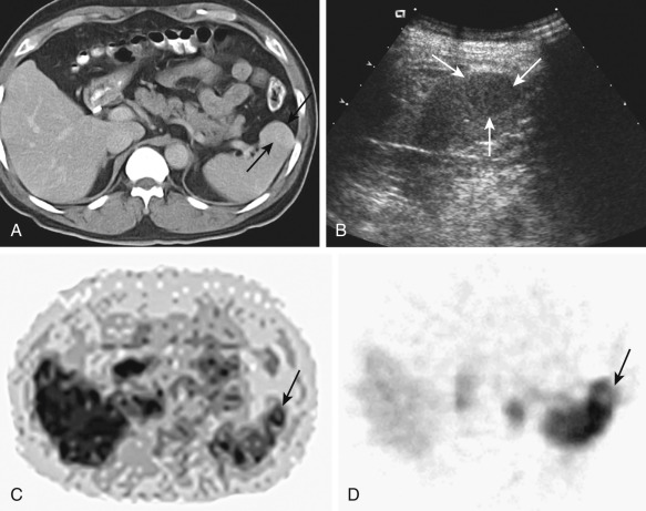 Figure 59-10, Splenic hamartoma. A, Axial contrast-enhanced computed tomography scan shows an isoattenuation mass (arrows) in the spleen, which is not discriminated from the surrounding spleen. Mild bulging contour may suggest the presence of the splenic abnormality. B, The ultrasonogram reveals a hypoechoic solid mass (arrows) with a well-defined margin. C, 99m Tc-scintigraphy shows a photopenic area in the corresponding lesion (arrow). D, Fluorodeoxyglucose–positron emission tomography (FDG-PET) reveals a non–FDG-avid lesion (arrow).