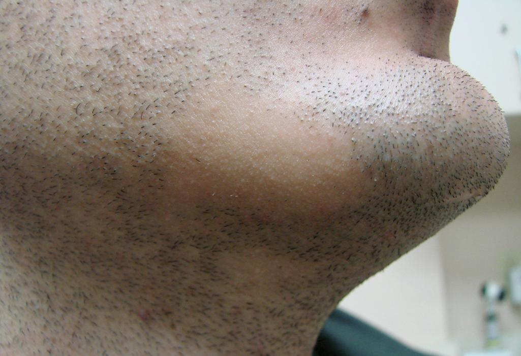 Fig. 14.2, Alopecia Areata.