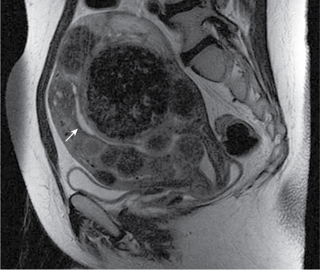 Fig. 32.1, Classification of fibroids on magnetic resonance imaging (MRI). Despite the presence of numerous fibroids that distort the endometrial canal, the location of the fibroids relative to the T2-hyperintense endometrium ( arrow ) can be readily assessed on MRI. Accurately characterizing fibroids as submucosal, intramural, or subserosal has implications for management.