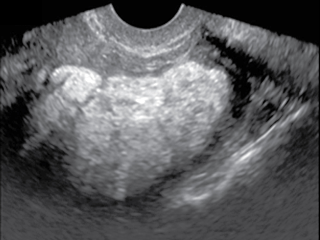 Fig. 32.2, Lipoleiomyoma. Longitudinal ultrasound image of the lower uterine segment shows a large, uniformly hyperechoic, nonshadowing mass, characteristic of fatty degeneration of a uterine fibroid.