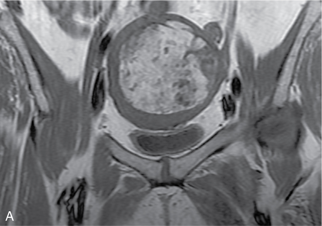 Fig. 32.3, Lipoleiomyoma on magnetic resonance imaging. A, On a coronal T1-weighted image, a large uterine mass is hyperintense relative to myometrium and similar in signal intensity to fat. B, This mass is markedly hypointense on a T2-weighted image with fat suppression, confirming the diagnosis of fatty degeneration of a uterine fibroid (lipoleiomyoma).