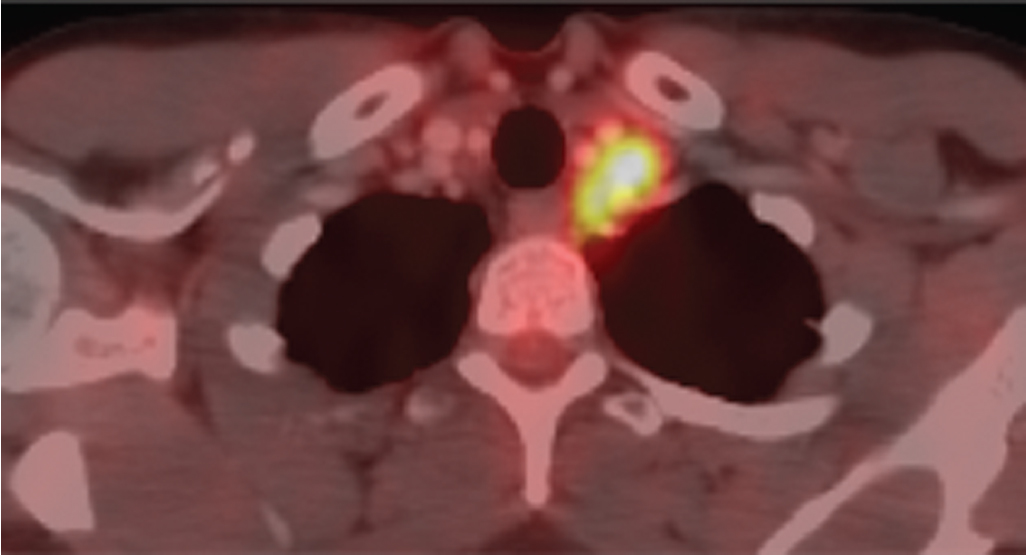 Fig. 32.4, Stage IVB cervical cancer. In a patient with invasive cervical squamous cell carcinoma, a hypermetabolic left supraclavicular lymph node is identified on positron emission tomography computed tomography, indicative of stage IVB disease.