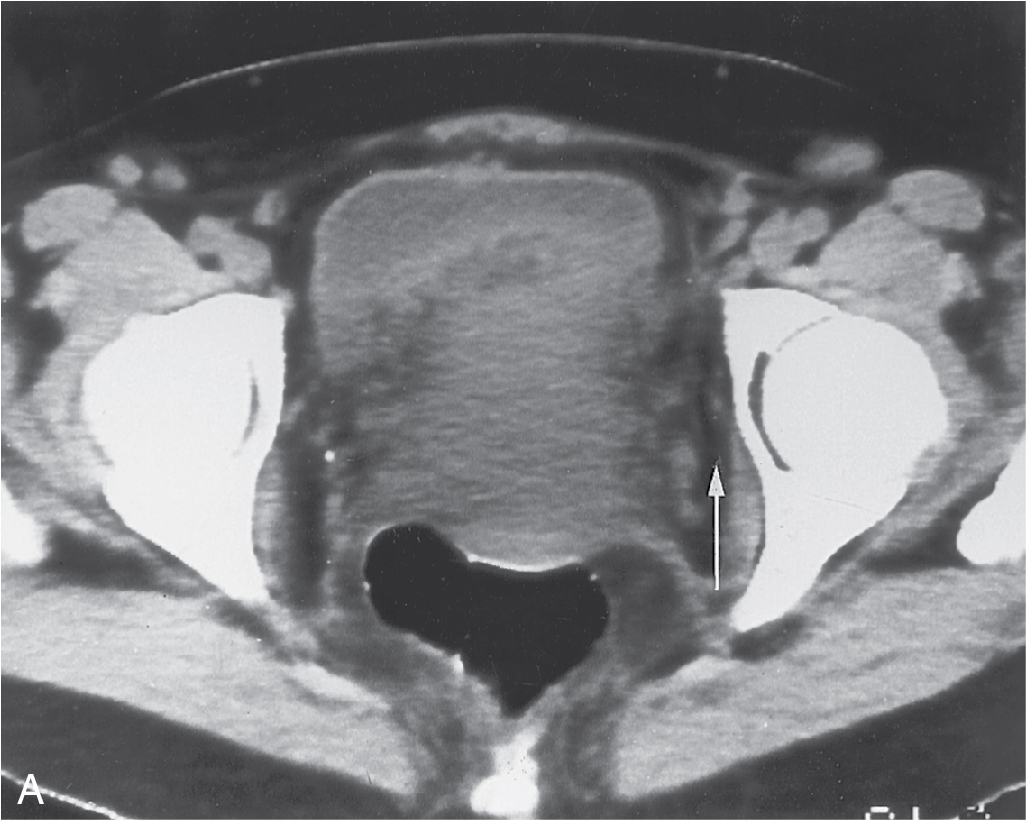 Fig. 32.5, Computed tomography (CT) findings of parametrial invasion by cervical cancer. A, Noncontrast pelvic CT demonstrates marked enlargement of the cervix, which has poorly defined margins; however, the fat planes ( arrow ) next to the obturator internus muscles are intact. This finding suggests spread to the parametrium but not to the pelvic wall. B, Secondary obstruction of the cervical canal results in hydrometra ( asterisk ).