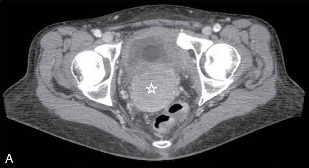 Fig. 32.6, Stage IIIB cervical carcinoma. A, The cervix (asterisk) is enlarged with poorly defined margins, suggestive of parametrial spread of tumor. Foley catheter is seen in the bladder. B, Left hydronephrosis is present with asymmetric enhancement of the left kidney (delayed nephrogram) secondary to parametrial extension of disease with distal ureteral obstruction.