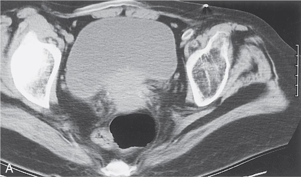 Fig. 32.7, Stage IVA cervical carcinoma. A, Noncontrast computed tomography of the pelvis demonstrates loss of the retrovesical fat plane adjacent to a cervical soft-tissue mass. The bladder wall is focally thickened at the site of tumor invasion. B, In another patient, there is more diffuse thickening of the bladder wall contiguous with a cervical carcinoma (asterisk) . In this patient, locally invasive tumor also has spread to the rectum.