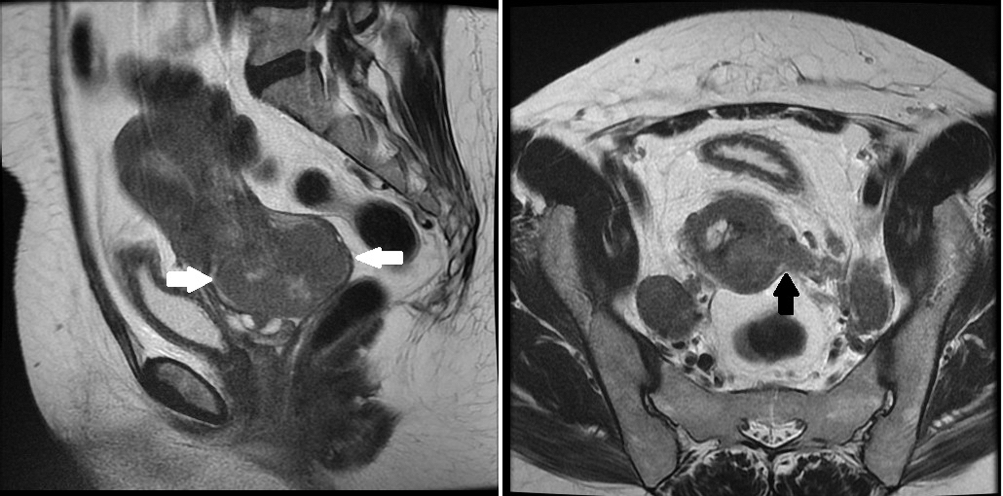 Fig. 32.8, Sagittal and transverse T2-weighted magnetic resonance images of a 46-year-old woman with a stage IIB cervical squamous cell carcinoma showing a heterogeneous mass in the cervix with lobulated margins, heterogeneously hyperintense T2 signal ( white arrows ) and a focus of parametrial invasion along the left lateral portion of the mass ( black arrow ).