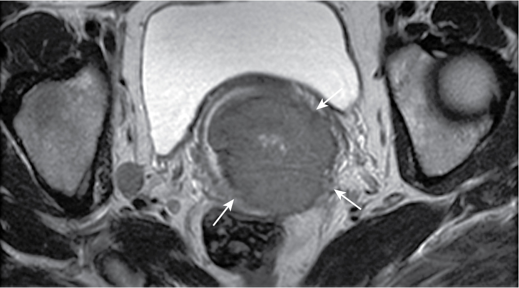 Fig. 32.9, Stage IIIB cervical carcinoma. In a patient with biopsy-proven squamous cell carcinoma of the cervix, there are several areas of disruption ( arrow ) of the T2-hypointense cervical stromal ring, consistent with parametrial invasion. Parametrial invasion precludes radical surgery.